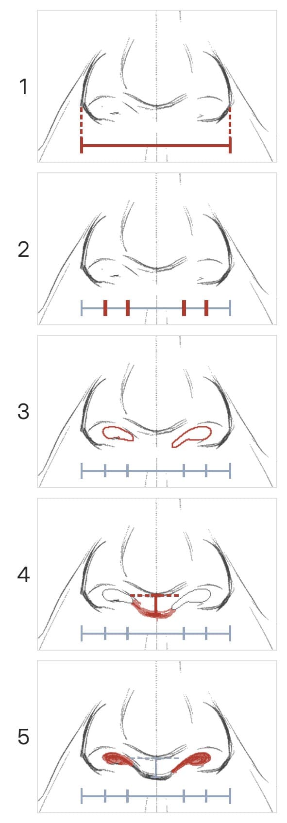 Five panels at the base of a nose from the front: the width, the width split into five, two light nostrils, the line under the tip, then the nostrils darkened